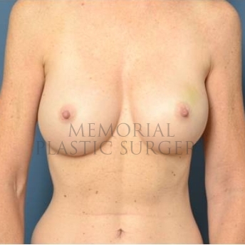 A front view before photo of patient 205 that underwent Nipple Sparing Mastectomy procedures at Memorial Plastic Surgery