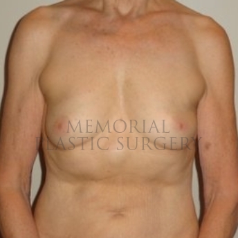 A front view before photo of patient 194 that underwent Nipple Sparing Mastectomy procedures at Memorial Plastic Surgery