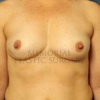 A front view before photo of patient 198 that underwent Nipple Sparing Mastectomy procedures at Memorial Plastic Surgery