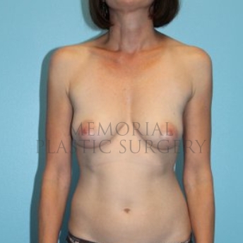 A front view before photo of patient 296 that underwent Nipple Sparing Mastectomy procedures at Memorial Plastic Surgery