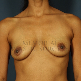 A front view before photo of patient 259 that underwent Nipple Sparing Mastectomy procedures at Memorial Plastic Surgery