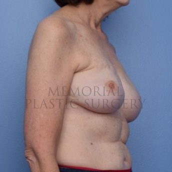 A oblique view after photo of patient 297 that underwent Nipple Sparing Mastectomy procedures at Memorial Plastic Surgery