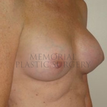 A oblique view after photo of patient 173 that underwent Nipple Sparing Mastectomy procedures at Memorial Plastic Surgery