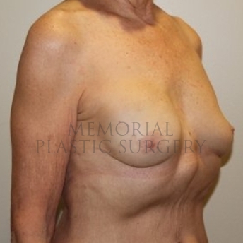 A oblique view after photo of patient 194 that underwent Nipple Sparing Mastectomy procedures at Memorial Plastic Surgery