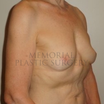 A oblique view before photo of patient 194 that underwent Nipple Sparing Mastectomy procedures at Memorial Plastic Surgery