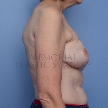 A side view after photo of patient 297 that underwent Nipple Sparing Mastectomy procedures at Memorial Plastic Surgery