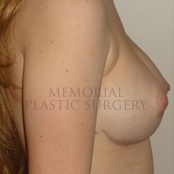 A side view after photo of patient 188 that underwent Nipple Sparing Mastectomy procedures at Memorial Plastic Surgery