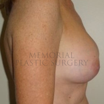 A side view after photo of patient 173 that underwent Nipple Sparing Mastectomy procedures at Memorial Plastic Surgery
