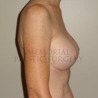A side view after photo of patient 205 that underwent Nipple Sparing Mastectomy procedures at Memorial Plastic Surgery