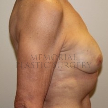 A side view after photo of patient 194 that underwent Nipple Sparing Mastectomy procedures at Memorial Plastic Surgery