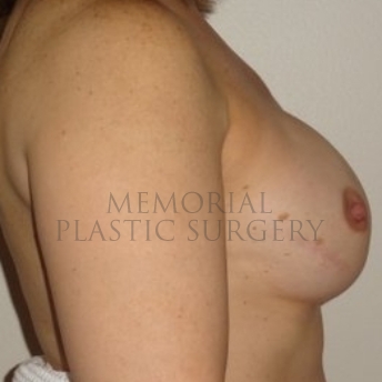 A side view after photo of patient 198 that underwent Nipple Sparing Mastectomy procedures at Memorial Plastic Surgery