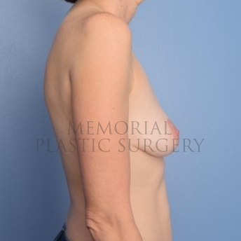 A side view after photo of patient 296 that underwent Nipple Sparing Mastectomy procedures at Memorial Plastic Surgery