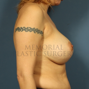 A side view after photo of patient 261 that underwent Nipple Sparing Mastectomy procedures at Memorial Plastic Surgery