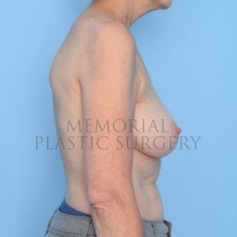 A side view before photo of patient 297 that underwent Nipple Sparing Mastectomy procedures at Memorial Plastic Surgery