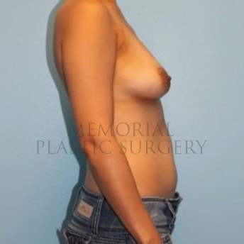A side view before photo of patient 695 that underwent Nipple Sparing Mastectomy procedures at Memorial Plastic Surgery