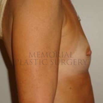 A side view before photo of patient 181 that underwent Nipple Sparing Mastectomy procedures at Memorial Plastic Surgery