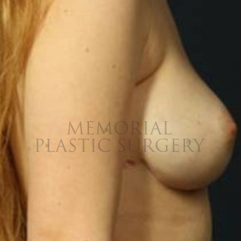 A side view before photo of patient 188 that underwent Nipple Sparing Mastectomy procedures at Memorial Plastic Surgery