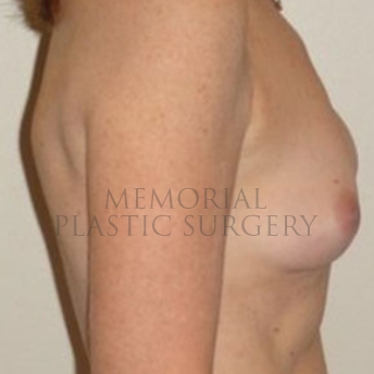 A side view before photo of patient 173 that underwent Nipple Sparing Mastectomy procedures at Memorial Plastic Surgery