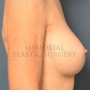 A side view before photo of patient 205 that underwent Nipple Sparing Mastectomy procedures at Memorial Plastic Surgery