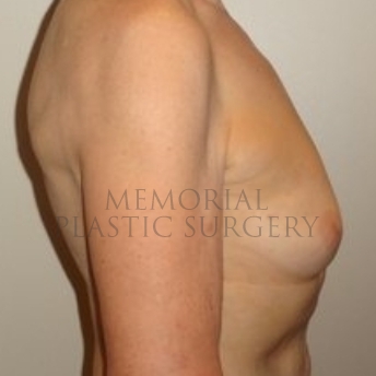 A side view before photo of patient 194 that underwent Nipple Sparing Mastectomy procedures at Memorial Plastic Surgery