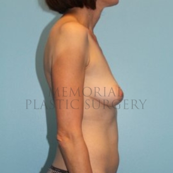 A side view before photo of patient 296 that underwent Nipple Sparing Mastectomy procedures at Memorial Plastic Surgery