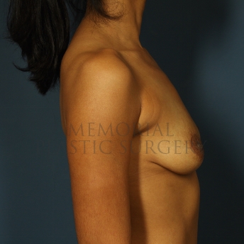 A side view before photo of patient 259 that underwent Nipple Sparing Mastectomy procedures at Memorial Plastic Surgery