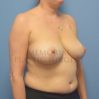 A oblique view before photo of patient 750 that underwent Nipple Sparing Mastectomy:Tissue Expander Implant:Liposuction procedures at Memorial Plastic Surgery