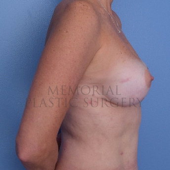 A side view after photo of patient 750 that underwent Nipple Sparing Mastectomy:Tissue Expander Implant:Liposuction procedures at Memorial Plastic Surgery
