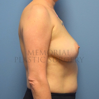 A side view before photo of patient 750 that underwent Nipple Sparing Mastectomy:Tissue Expander Implant:Liposuction procedures at Memorial Plastic Surgery