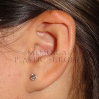 A oblique view before photo of patient 185 that underwent Otoplasty procedures at Memorial Plastic Surgery