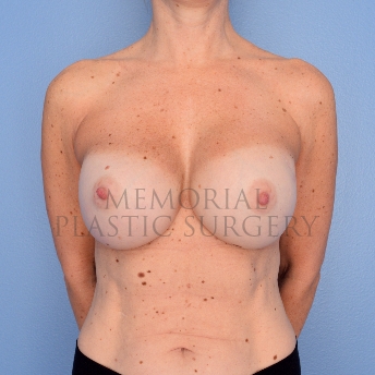 A front view after photo of patient 749 that underwent Revisional Breast Surgery procedures at Memorial Plastic Surgery