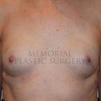 A front view after photo of patient 176 that underwent Revisional Breast Surgery procedures at Memorial Plastic Surgery