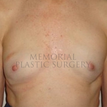 A front view before photo of patient 176 that underwent Revisional Breast Surgery procedures at Memorial Plastic Surgery