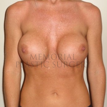 A front view before photo of patient 201 that underwent Revisional Breast Surgery procedures at Memorial Plastic Surgery