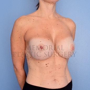 A oblique view after photo of patient 749 that underwent Revisional Breast Surgery procedures at Memorial Plastic Surgery