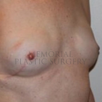 A oblique view after photo of patient 176 that underwent Revisional Breast Surgery procedures at Memorial Plastic Surgery