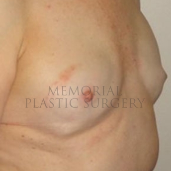 A oblique view before photo of patient 176 that underwent Revisional Breast Surgery procedures at Memorial Plastic Surgery