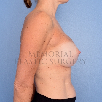 A side view after photo of patient 749 that underwent Revisional Breast Surgery procedures at Memorial Plastic Surgery