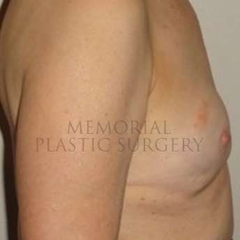 A side view before photo of patient 176 that underwent Revisional Breast Surgery procedures at Memorial Plastic Surgery