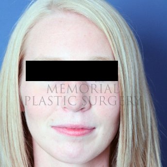 A front view after photo of patient 217 that underwent Rhinoplasty procedures at Memorial Plastic Surgery