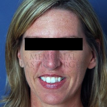 A front view after photo of patient 216 that underwent Rhinoplasty procedures at Memorial Plastic Surgery
