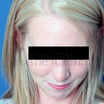 A oblique view after photo of patient 217 that underwent Rhinoplasty procedures at Memorial Plastic Surgery