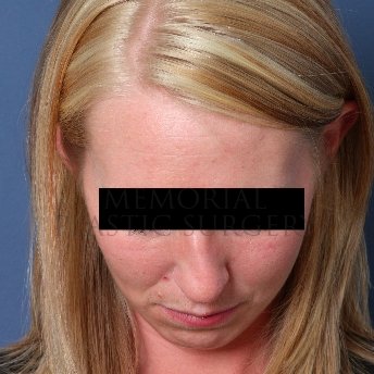 A oblique view before photo of patient 217 that underwent Rhinoplasty procedures at Memorial Plastic Surgery