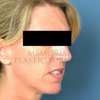 A oblique view before photo of patient 216 that underwent Rhinoplasty procedures at Memorial Plastic Surgery