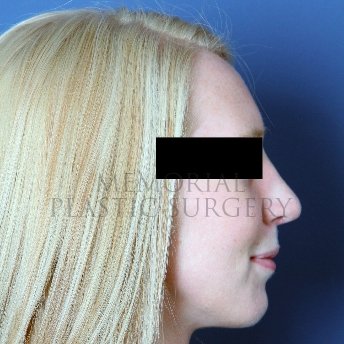 A side view after photo of patient 217 that underwent Rhinoplasty procedures at Memorial Plastic Surgery