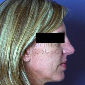 A side view after photo of patient 216 that underwent Rhinoplasty procedures at Memorial Plastic Surgery