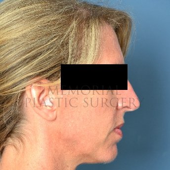 A side view before photo of patient 216 that underwent Rhinoplasty procedures at Memorial Plastic Surgery