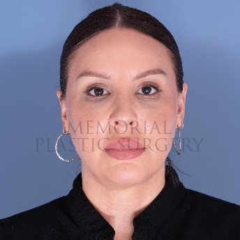 A front view after photo of patient 4125 that underwent Rhinoplasty:Septoplasty procedures at Memorial Plastic Surgery