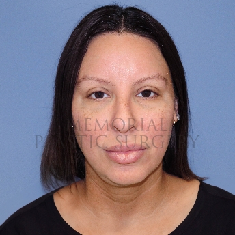 A front view before photo of patient 4125 that underwent Rhinoplasty:Septoplasty procedures at Memorial Plastic Surgery