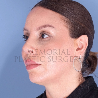 A oblique view after photo of patient 4125 that underwent Rhinoplasty:Septoplasty procedures at Memorial Plastic Surgery